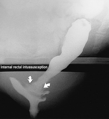 rectal intussusception